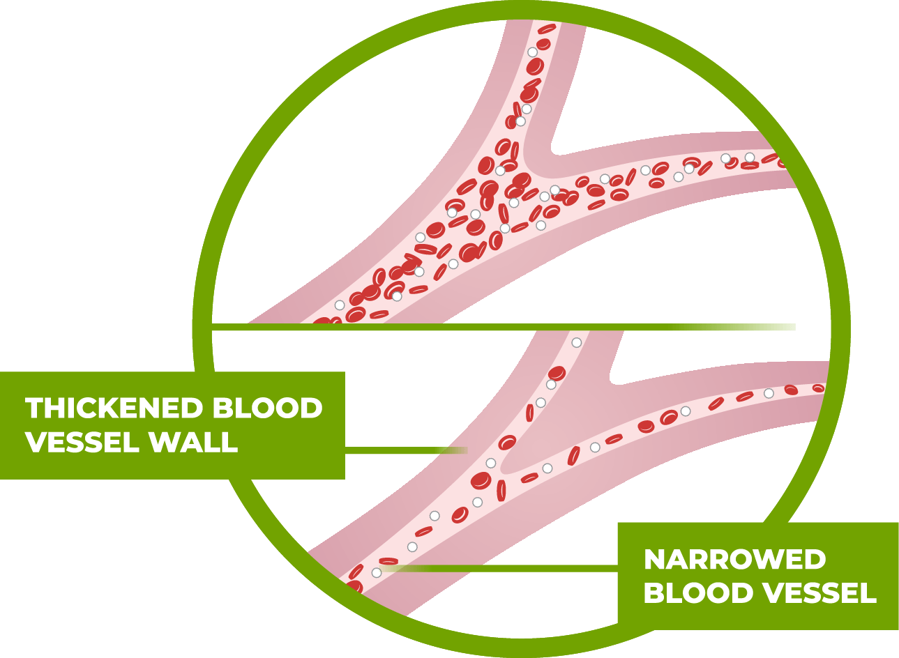 Side by side: healthy vessel, vessel with PAH.